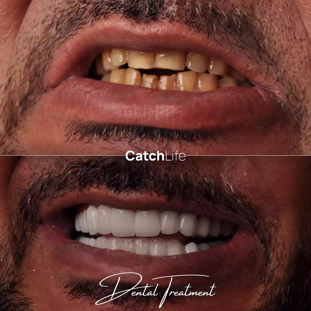 dental implant before after
