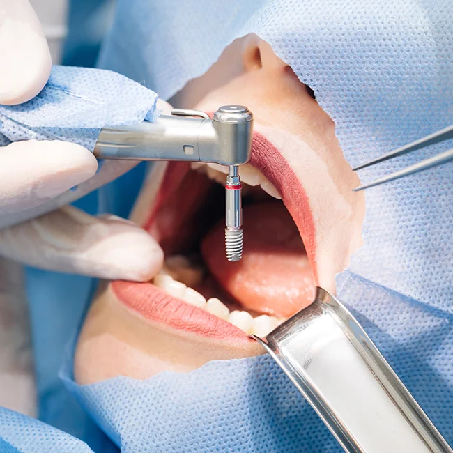 dental implant