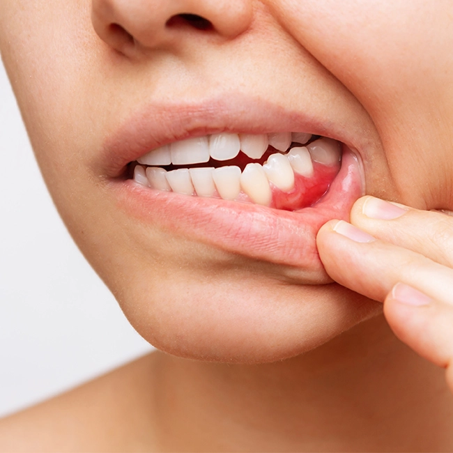gingivectomy