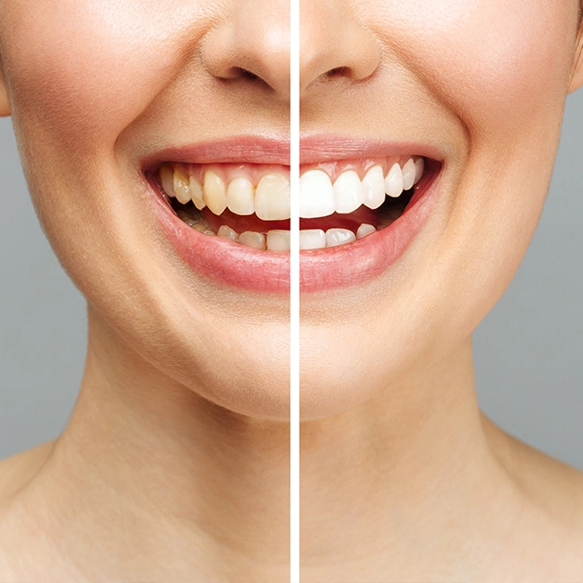 teeth whitening